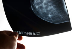 Photo of a mammogram x-ray film