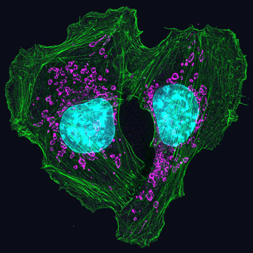 Skin cancer cells